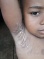 Sindrome De Brote