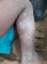 Sindrome De Brote